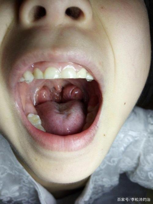 扁桃体肥大必须手术治疗吗?