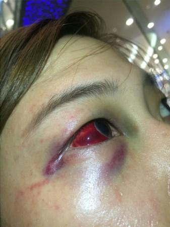 杨某眼角出现淤青,眼睛红肿