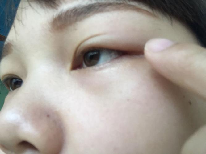 你好!我左眼昨天突然有点痛今天就肿了上眼皮,不知道怎么回事?