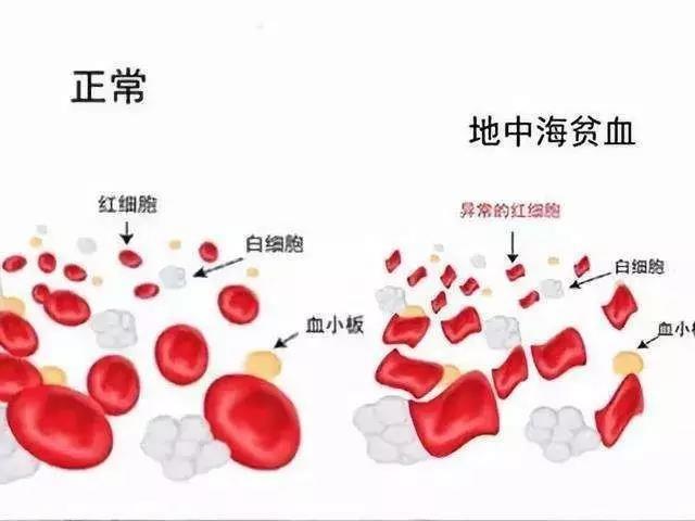 地中海脱发;地中海贫血基因检测