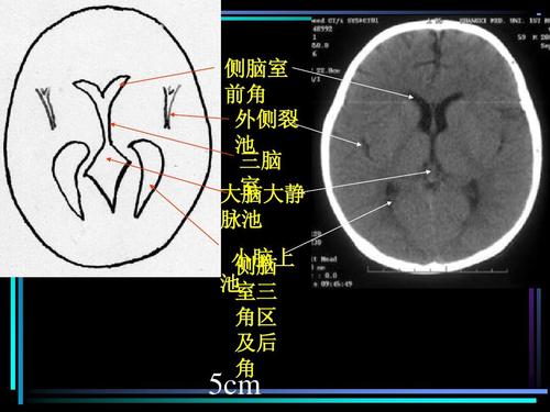 免费文档 所有分类 医药卫生 头颅ct解剖ppt 正常头颅ct解剖 侧脑室