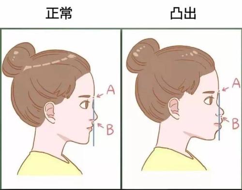 潍坊耳鼻喉专家带你了解腺样体面容