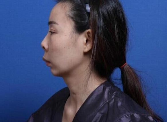 感觉鼻子像没有做的一样,整个侧脸没有一点美感.