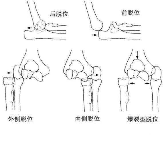 肘关节脱位的分析与治疗