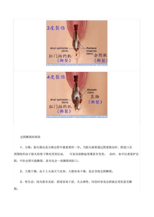 分娩时会阴撕裂伤分级示意图.pdf 5页