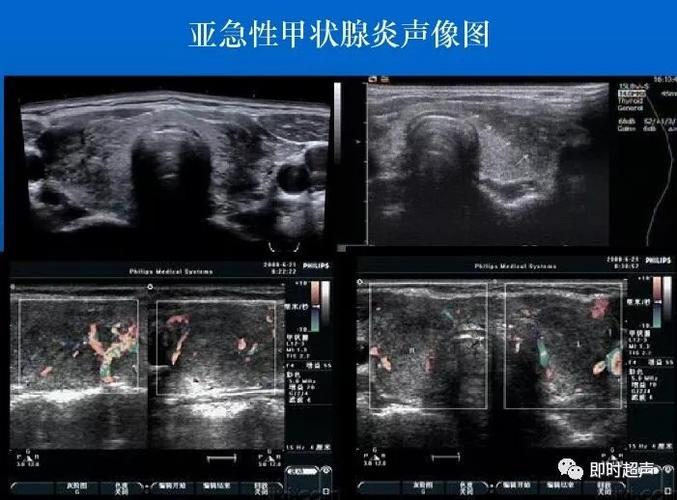 常见甲状腺疾病的超声诊断:解剖,声像图及正常值