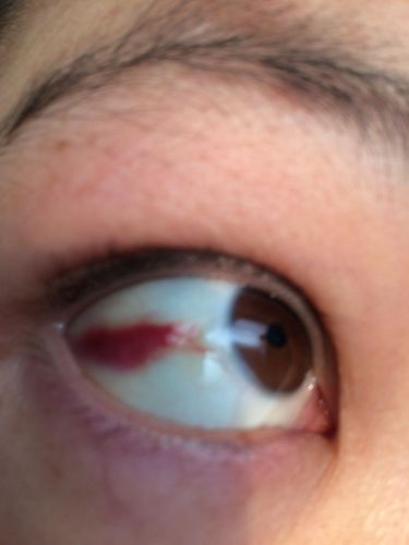 眼睛里面有红块怎么回事,今天早上老公发现的,吃药过敏会不会出现这种