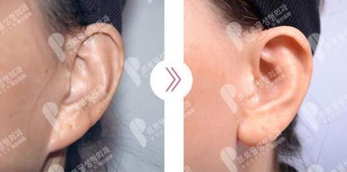 普罗菲耳整形医院各类耳垂整形方法