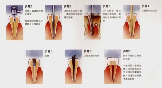 根管治疗基本步骤 图解>