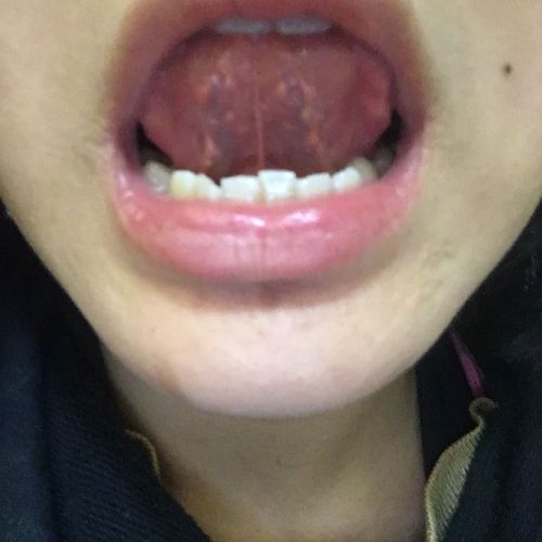 舌头上的小肉怎么回事,是尖锐吗,百度说这是尖锐什么鬼的