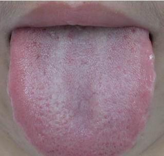 舌苔中间有裂纹是大病的征兆?辟谣:可能不是病理原因注意几点