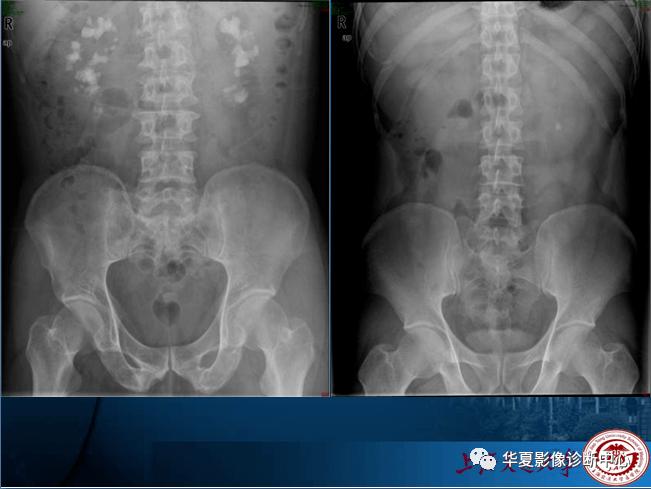 手把手教你阅读平片之腹部平片与消化道造影