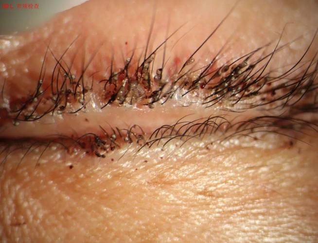 女子瘙痒难忍,医生都惊呆了