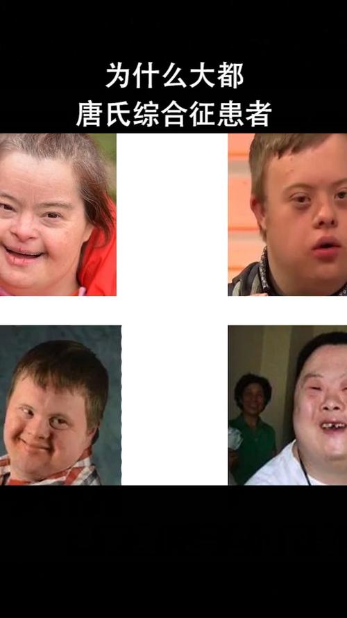 为什么大都唐氏综合征患者,长得都差不多?