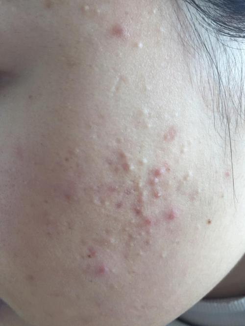 导语:痤疮是一种非炎性丘疹形成时,皮脂腺导管的毛囊堵塞.