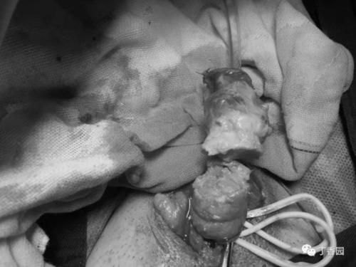 抑郁症患者切下自己的阴茎和睾丸,医生是如何缝回去的