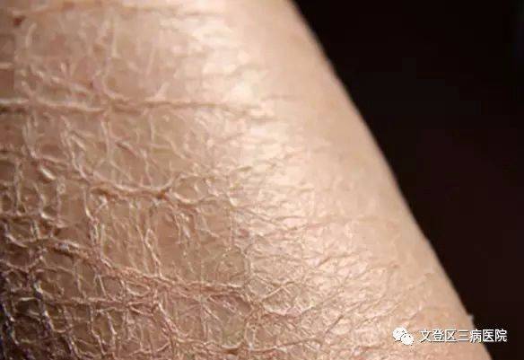 显性遗传先天性鱼鳞病样红皮病又名鱼鳞病