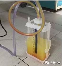 一文学会胸腔积液鉴别,就是这篇没错了!