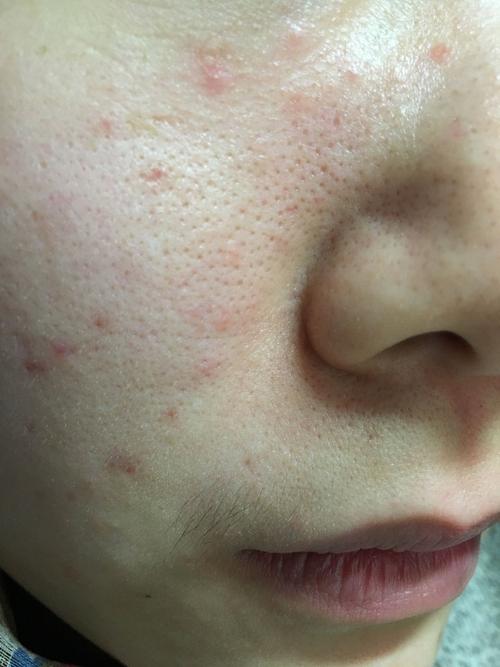 皮肤状态好差!同时还发痘痘去不了痘印!求大神解答