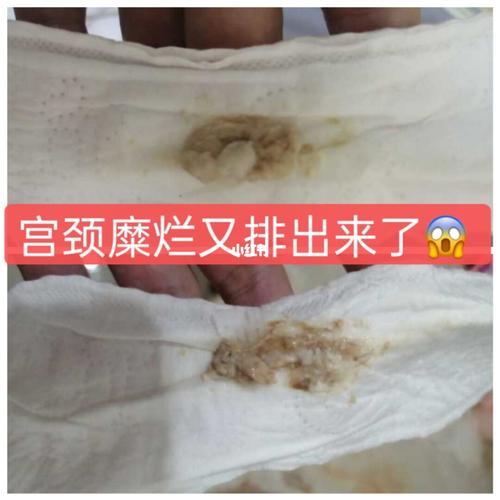 又排出了垃圾毒素 05_宫颈糜烂_邳州市港上镇卫生院