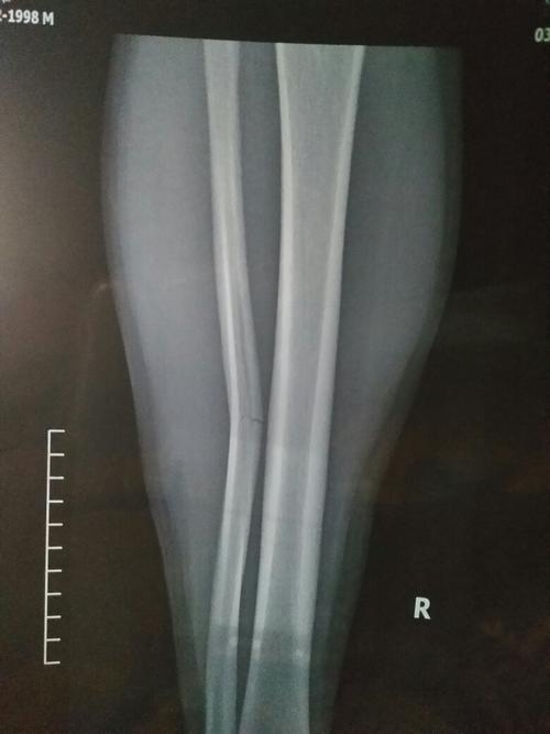 右腿腓骨骨折,恢复期运动不当再次将伤口崩开,现在活动时扔有感觉,想