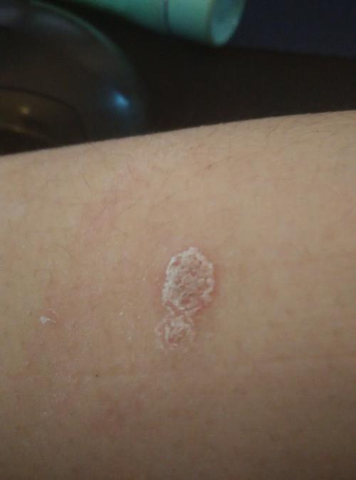 请问这是什么癣,还是别的病