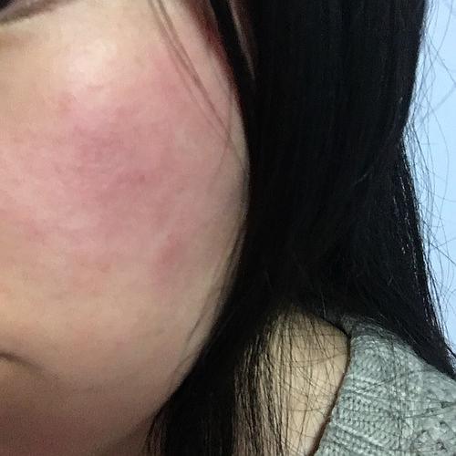 用面膜过敏了怎么办啊摔!