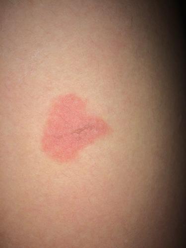 请问一下大家,我的腿上无缘无故这么红了一块,开始有点难受,到现在都3