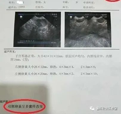 别把多囊卵巢和不孕划等号,国粹银针也能有奇效