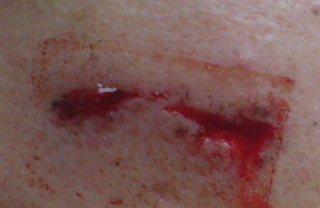 我脸受伤了有图,怎么办