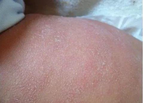 海宁1岁半宝宝皮肤比老人还粗糙原因吓一跳