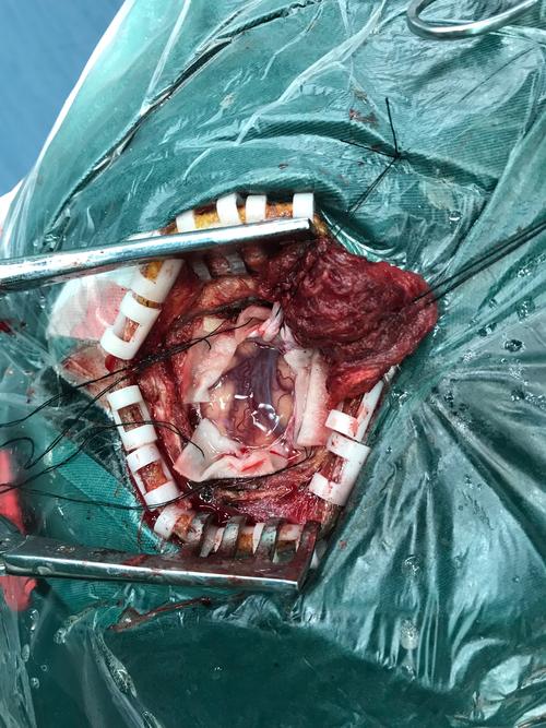 畸形出血  63岁女性患者,因意识不清来院就诊,ct检查提示存在脑出血