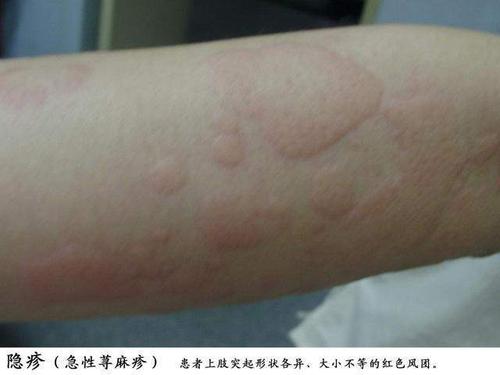 急性荨麻疹