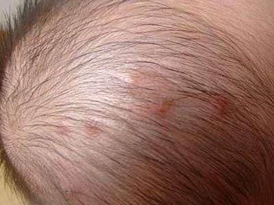 婴儿痤疮(infantileacne)又称新生儿痤疮(acneneonatorum).