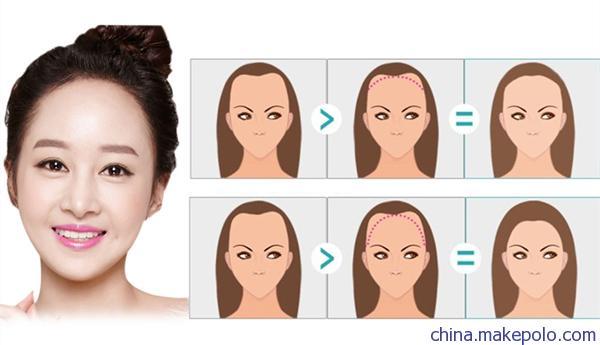 男女发际线调整修复 发际线后移修补 生物头皮无痕补发技术