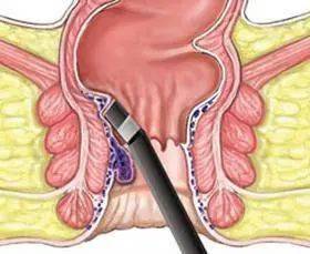 痔疮发展到第四个阶段就太晚了!_肛门