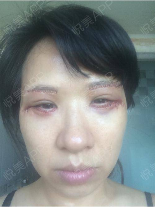 2015年6月做了外切提拉去眼袋和提眉,其实本来眼袋就不太明显,可是我