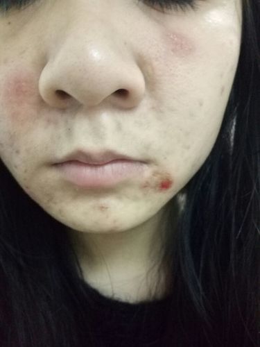 脸部湿疹还是皮炎还是螨虫?一块一