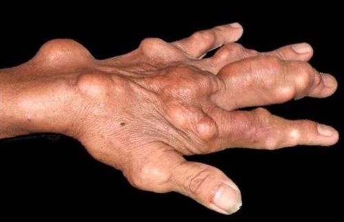 高尿酸血症并发症不止痛风,还有这些危害!