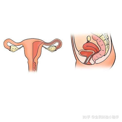 什么是子宫息肉