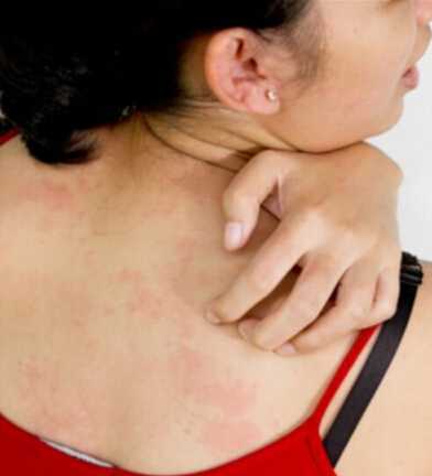 皮肤过敏有哪些症状 皮肤过敏症状图片