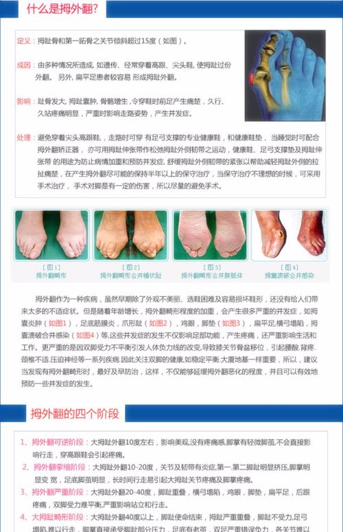 拇外翻分趾器日用大脚骨小拇指护套器拇指外翻矫正器wd-541326