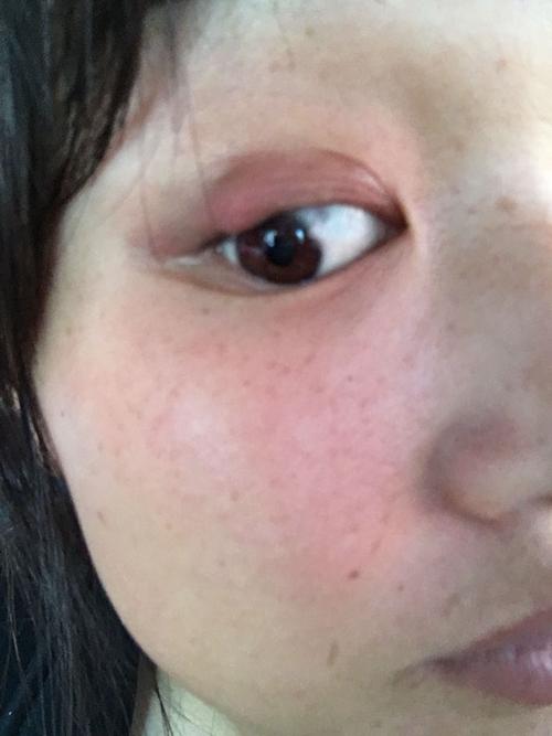 一月前右眼皮出现红肿疼痛,目前长成疙瘩不痛不痒,怎么才可以消除?