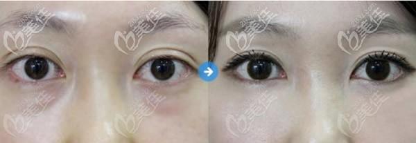 不是说手术去眼袋不会反弹吗为啥我割眼袋一年后又复发再长了