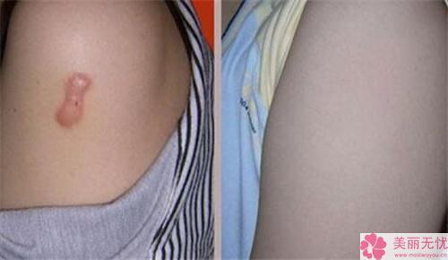 首页 整形资讯 项目资讯 >> 激光修复疤痕有什么美化效果     伤疤不