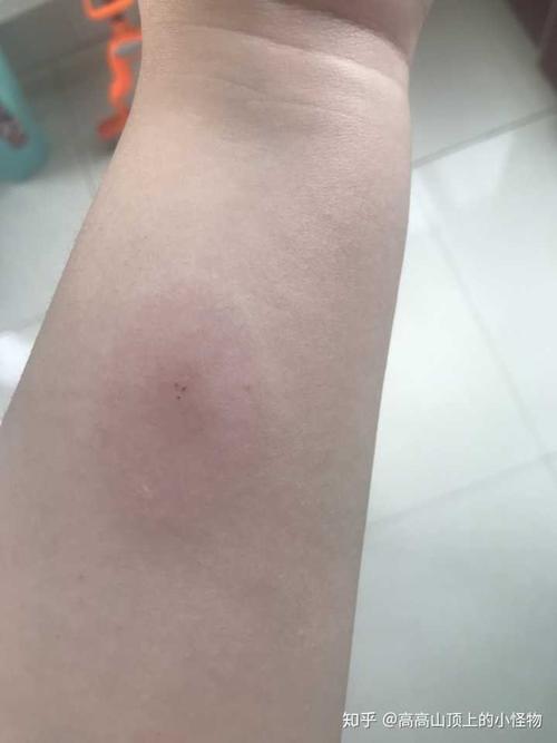 室友得了肺结核,我去皮试50个小时了,拍片说肺没事,但是我昨天嗓子就