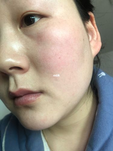 脸上的干皮是昨天晚上涂的芦荟胶干的起来的 不是皮肤起来的干皮呦