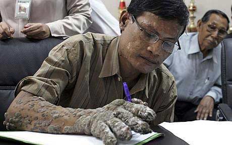 印尼『树人』手术后树皮复生 今后每年最少割两次