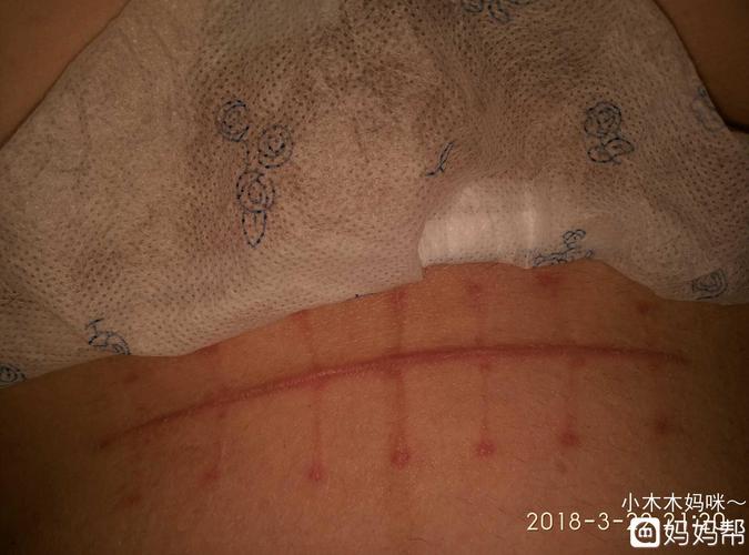〈有图慎入〉这是疤痕增生吗