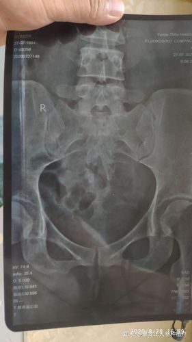 有没有大神帮我看下,这个片子,尾椎骨疼痛,拍片子,医生说正常,回家